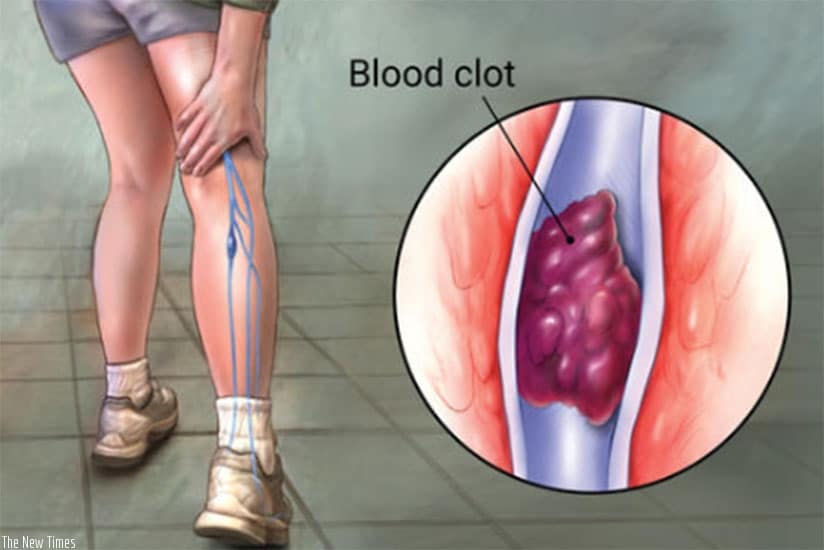DVT prevention
