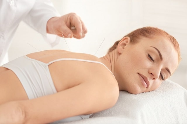 acupuncture