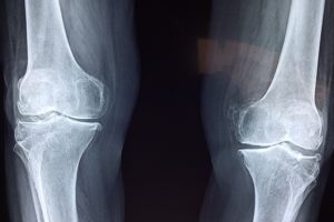 Joint Cartilage