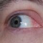 Best Stye Remedies