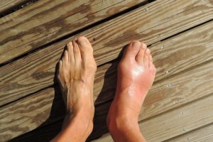 Best Bunion Correctors